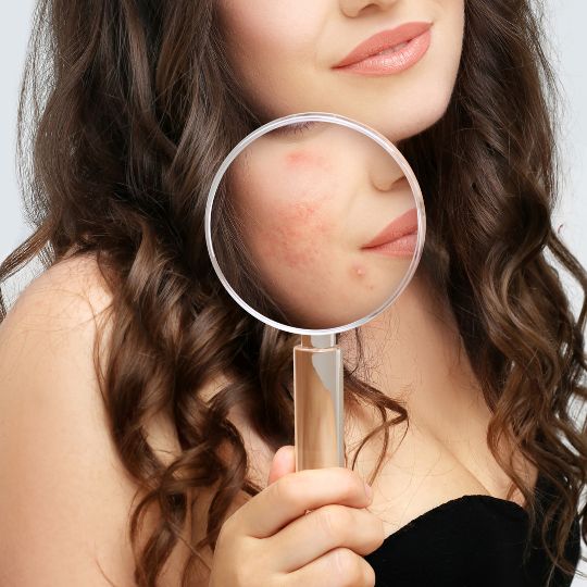 Woman with Magnifying Glass on her rosacea